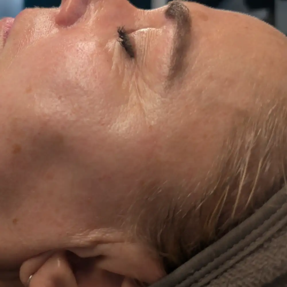 Po ošetrení: ABR PRO – biorevitalizačné ošetrenie – Klientka, 52 r. — po prvom sedení