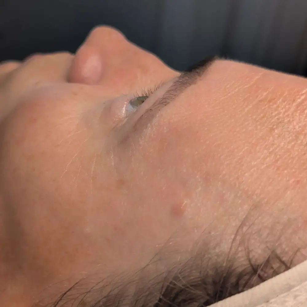 Po ošetrení: ABR PRO – biorevitalizačné ošetrenie – Klientka, 38 r. — po prvom sedení (2. pohľad)