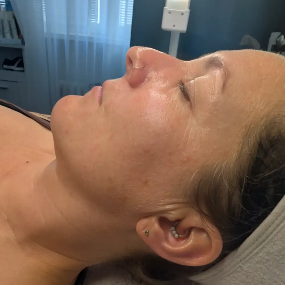 Po ošetrení: ABR PRO – biorevitalizačné ošetrenie – Klientka, 42 r. — prvé ošetrenie