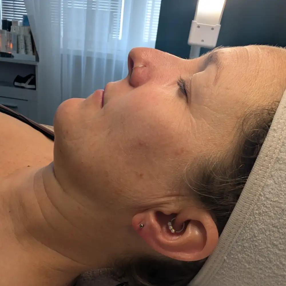 Pred ošetrením: ABR PRO – biorevitalizačné ošetrenie – Klientka, 42 r. — prvé ošetrenie