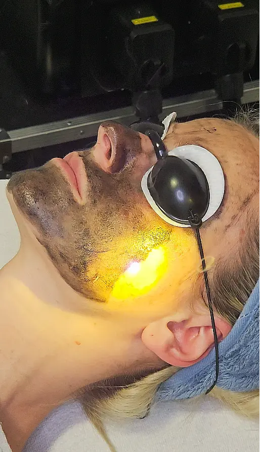 CarbonPeel