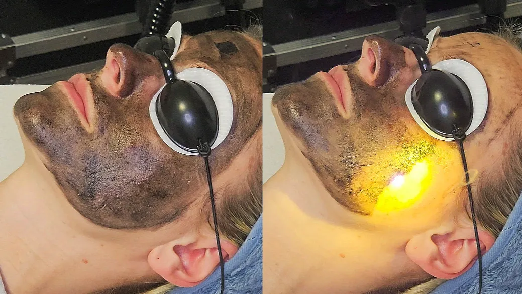 CarbonPeel
